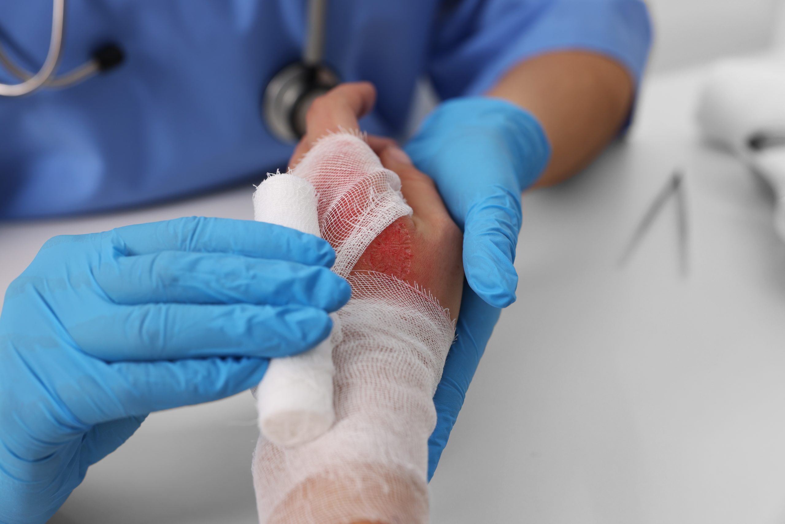 Burn Injuries